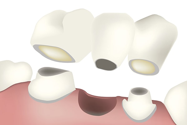 Bridges is another alternative to replace missing teeth
