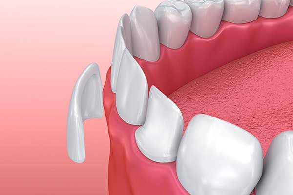 Porcelain Veneers can dramatically change your smile to the smile of your dreams