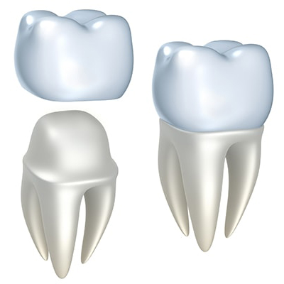 A graphic of a dental crown