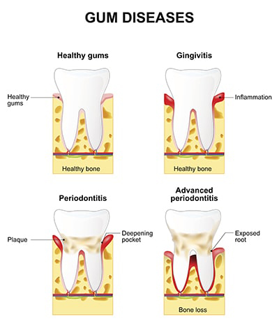Scaling and Root Planing is a deep cleaning for your smile to stop gum disease.