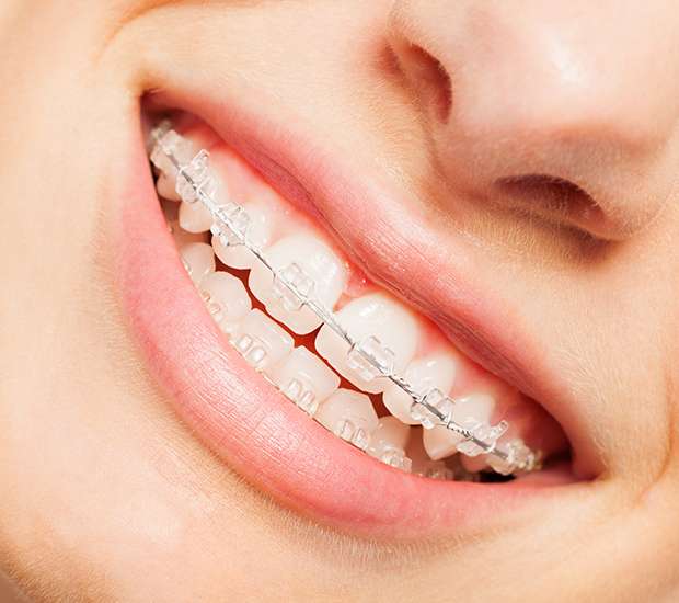 Troy Clear Braces