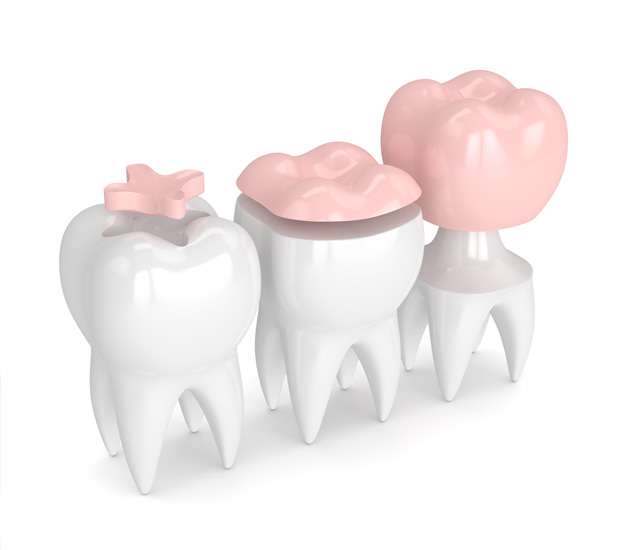 Troy Dental Inlays and Onlays