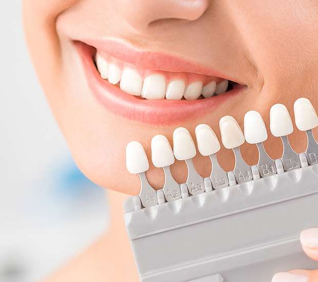 Troy Dental Veneers and Dental Laminates