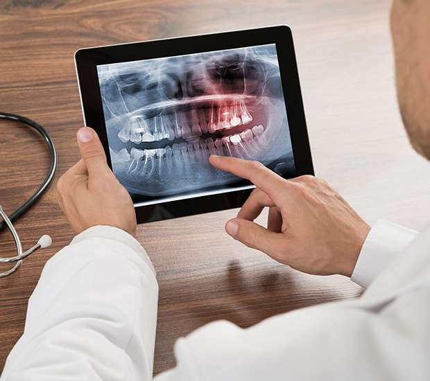 Troy Types of Dental Root Fractures