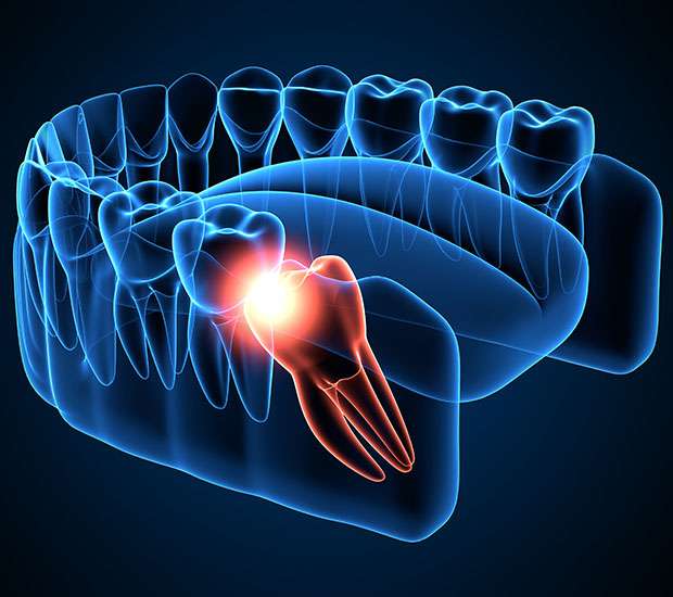 Troy Wisdom Teeth Extraction